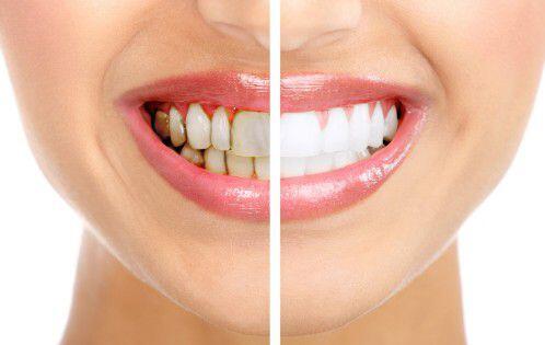 Nguyên nhân và cách chữa trị răng ố vàng