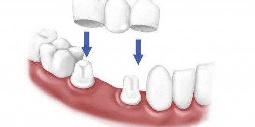 Những hạn chế của phương pháp cầu răng