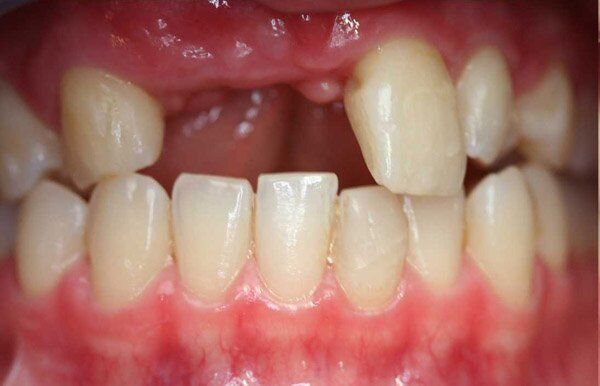 Mất nhiều răng ở người lớn tuổi phải làm sao?