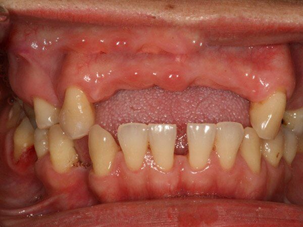 Mất răng lâu năm có trồng lại được không?