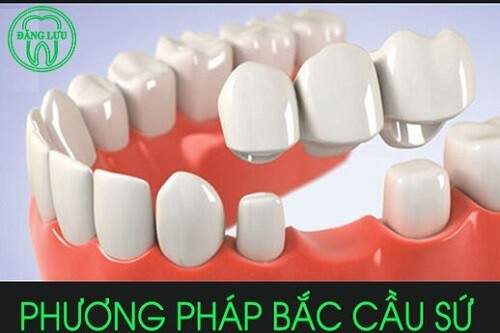 Miễn phí trụ Implant Hàn Quốc - Trồng răng không đau Digital sóng rung DentalVibe 7