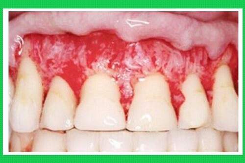 Miếng dán tẩy trắng răng có thật sự tốt? 2