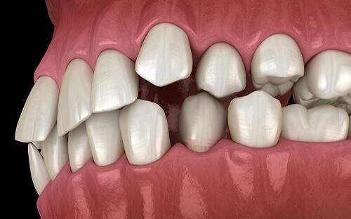Nâng khớp cắn trong niềng răng là gì? 1