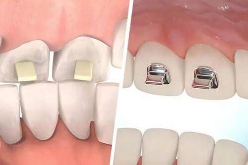 Nâng khớp cắn trong niềng răng là gì? 2