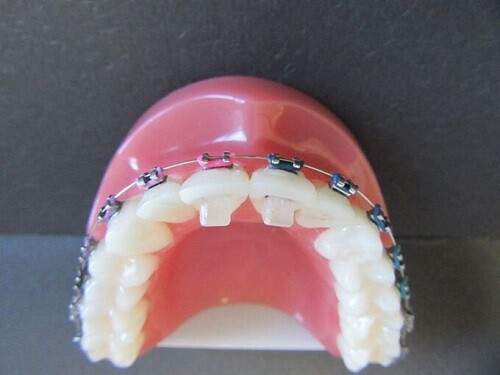 Nâng khớp cắn trong niềng răng là gì? 3