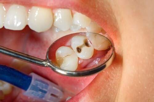 Người già và bệnh răng miệng thường gặp 2