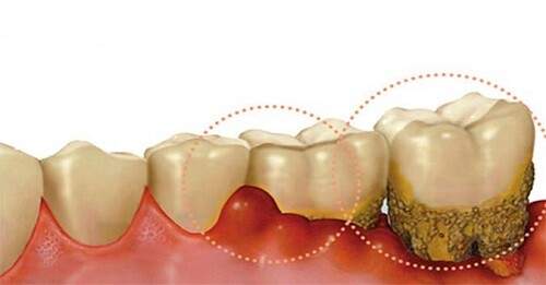 Nguy cơ mất răng từ triệu chứng sưng lợi thông thường 2