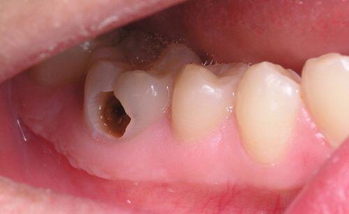 Lấy tủy răng có đau không? Lấy tủy răng ở đâu UY TÍN nhất 1