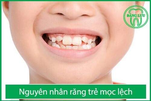 Nguyên nhân răng mọc lệch ở trẻ và cách khắc phục 1