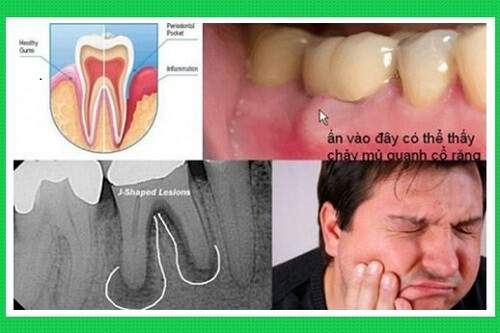 Nguyên nhân viêm quanh cuống răng và những triệu chứng cần biết 3