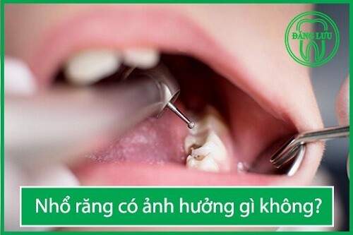 Nhổ răng có ảnh hưởng tới sức khỏe không ? 2