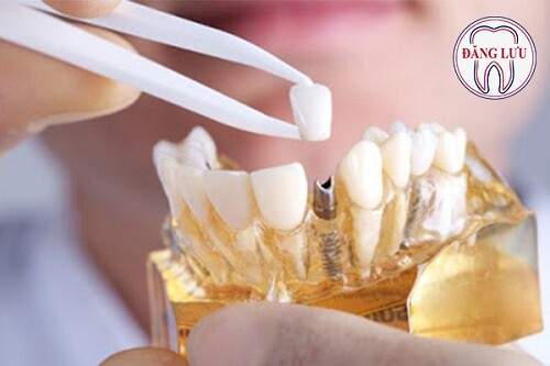 Nhổ răng có ảnh hưởng tới sức khỏe không ? 3