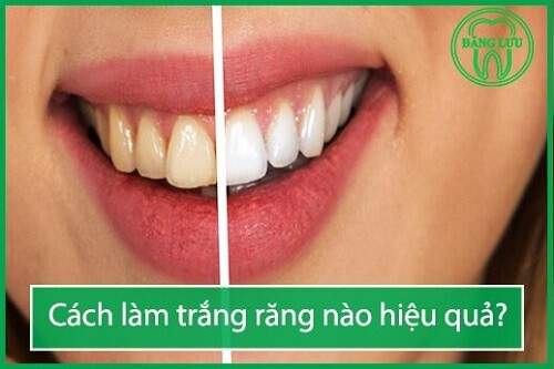 Những cách làm trắng răng tại nha khoa hiện nay 1