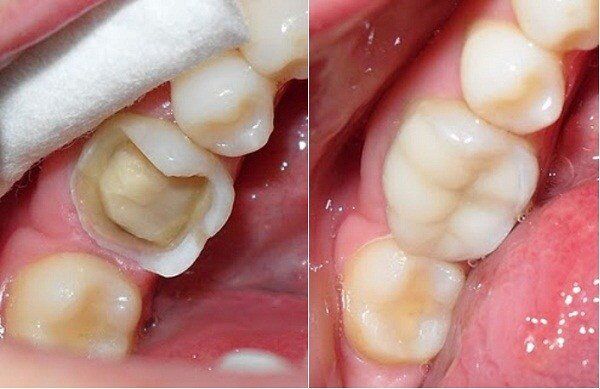 những nguyên nhân làm men răng bị mòn