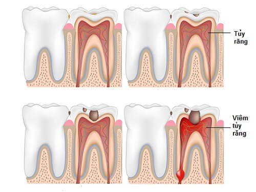 Những tai biến và biến chứng trong bọc răng sứ