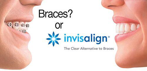 Những ưu điểm nổi bật của niềng răng Invisalign G6