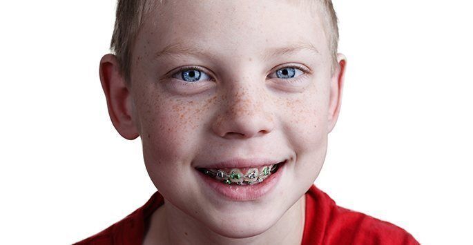 niềng răng chỉnh nha cho trẻ