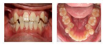 Niềng răng không nhổ răng có giúp giảm hô không
