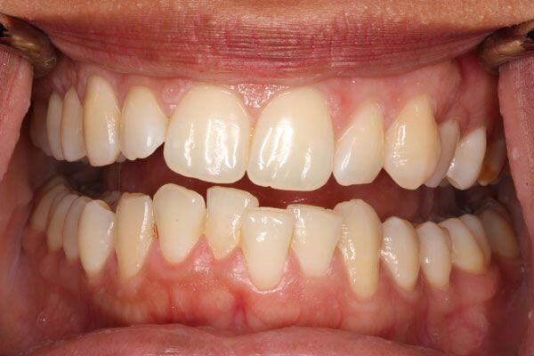 bọc răng sứ cho răng mọc lệch 