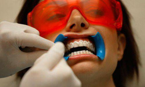 Phương pháp tẩy trắng răng an toàn nào tốt nhất?