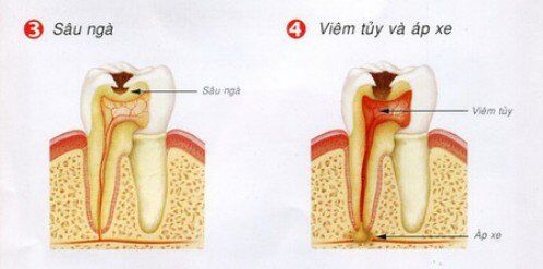 Qúa trình hình thành sâu răng