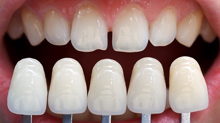 Răng sứ Veneer là gì? 3