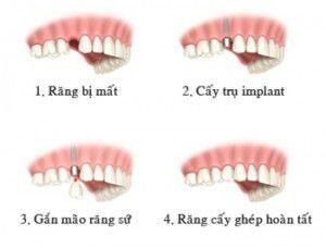 Quy trình cấy ghép răng implant hiệu quả cao 2