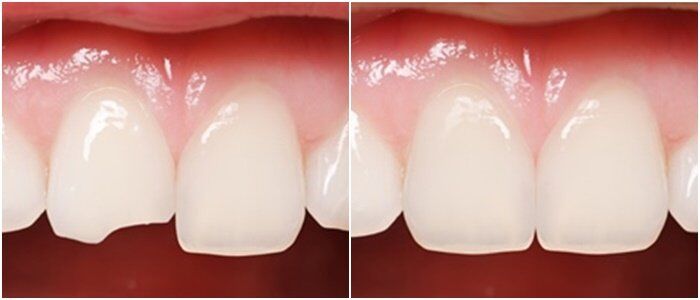  Răng được phục hình không kém răng sứ 