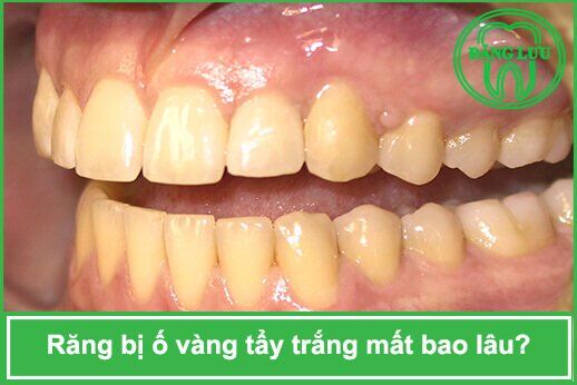 Tham khảo một số cách làm trắng răng bị ố vàng đơn giản ngay tại nhà