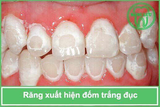 Răng xuất hiện đốm trắng đục là bệnh gì