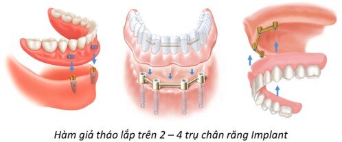 Ghép implant trong trường hợp mất răng hoàn toàn