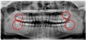 Dấu hiệu và triệu chứng mọc răng khôn ở người lớn 3