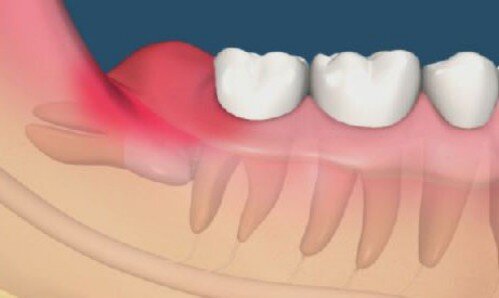 Dấu hiệu và triệu chứng mọc răng khôn ở người lớn 1