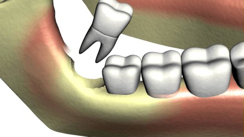 Làm gì khi răng khôn hàm dưới mọc lệch? 3
