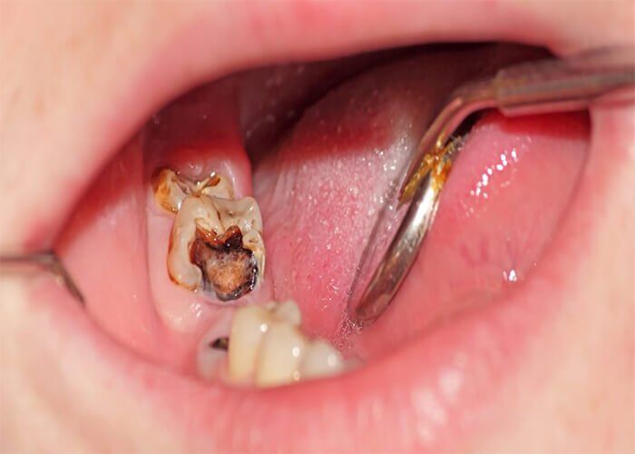 răng chữa tủy khi bị sâu