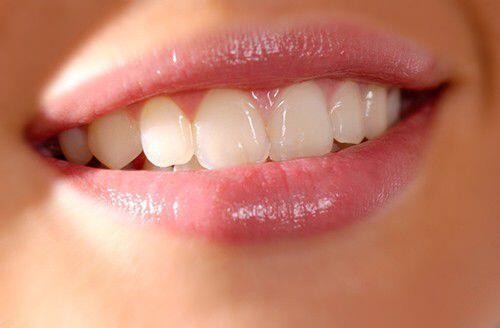 răng sứ không kim loại có bị xỉn màu không