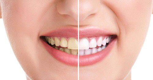Mẹo với phương pháp tẩy trắng răng tự nhiên 4