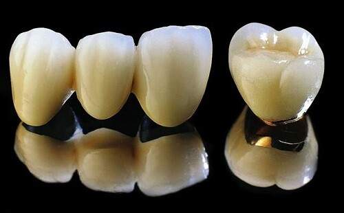 Răng sứ kim loại thường có tốt không ? 1