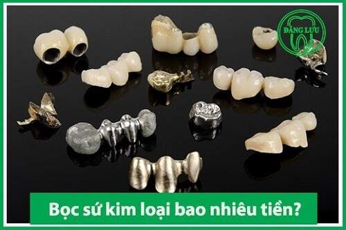 Răng sứ kim loại thường có tốt không ? 2