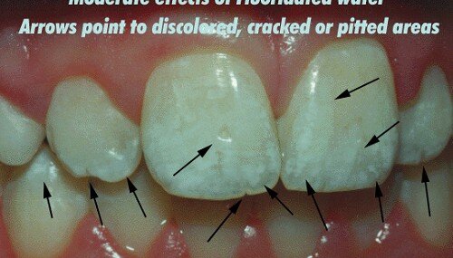 Bọc răng sứ cho răng nhiễm fluor