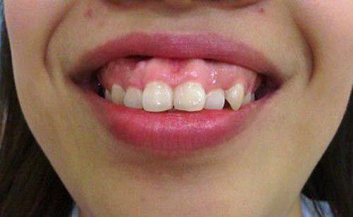 Niềng răng cho trường hợp răng hô điều trị thế nào ?