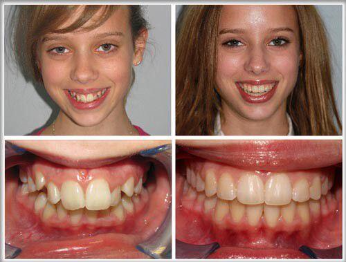 Nghiến răng ảnh hưởng thế nào tới sức khỏe răng miệng ?