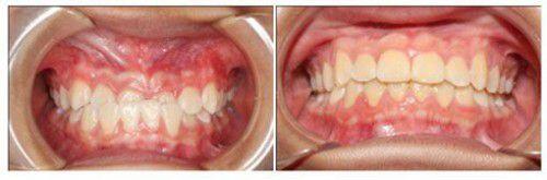 Răng vẩu có di truyền không ?