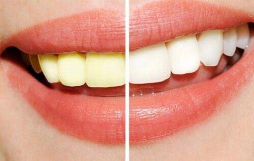 Sau khi tẩy trắng răng có phải kiêng cữ gì không ? 2