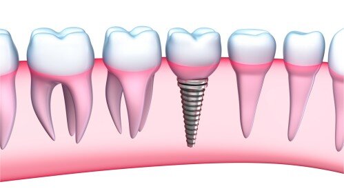 Phương pháp thay thế răng mất mà không làm cầu răng
