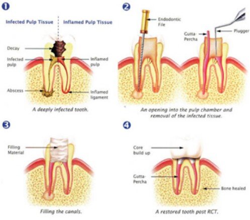 Sự khác biệt giữa viêm tủy răng hồi phục và không hồi phục