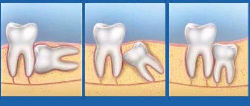 Sự khác nhau giữa răng khôn và răng hàm