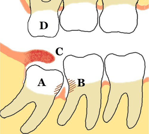 Sưng nướu răng trong cùng có ảnh hưởng gì không? 1