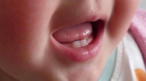 Răng mọc chậm để lâu dễ biến chứng