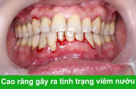 tác hại của vôi răng